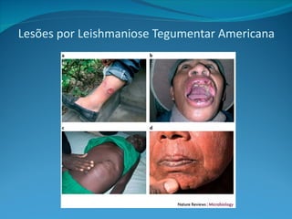 Lesões por Leishmaniose Tegumentar Americana
 