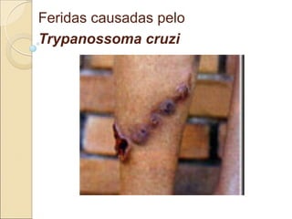Feridas causadas pelo
Trypanossoma cruzi
 