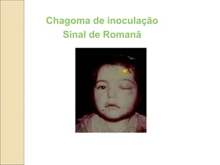 Chagoma de inoculação
Sinal de Romanã
 