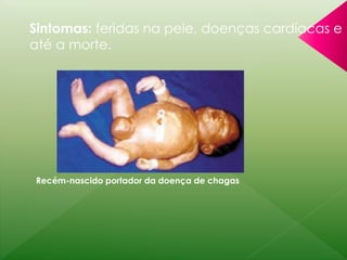 Sintomas: feridas na pele, doenças cardíacas e 
até a morte. 
Recém-nascido portador da doença de chagas 
 