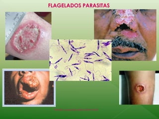 FLAGELADOS PARASITAS 
Feridas causadas pela Leishmania 
 