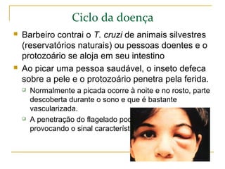 Ciclo da doença
 Barbeiro contrai o T. cruzi de animais silvestres
(reservatórios naturais) ou pessoas doentes e o
protozoário se aloja em seu intestino
 Ao picar uma pessoa saudável, o inseto defeca
sobre a pele e o protozoário penetra pela ferida.
 Normalmente a picada ocorre à noite e no rosto, parte
descoberta durante o sono e que é bastante
vascularizada.
 A penetração do flagelado pode ocorrer pelo olho,
provocando o sinal característico da infecção.
 