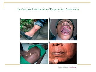 Lesões por Leishmaniose Tegumentar Americana
 