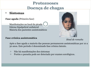 Protozooses
                    Doença de chagas
• Sintomas
Fase aguda (Primeira fase)

   Manifestações no local da picada
   Edema bipalpebral unilateral
   Maioria dos pacientes assintomáticos


Fase crônica assintomática
                                                          Sinal de romaña
   Após a fase aguda a maioria das pessoas permanecem assintomáticas por 10 a
   30 anos. Este período é denominado fase crônica latente.

    o   Não há manifestações dos sintomas
    o   Porém o parasita pode ser detectado por exames sorológicos.
 