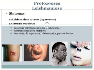 Protozooses
                       Leishmaniose
• Sintomas:
 a) Leishmaniose cutânea (tegumentar)
 Leishmania brasiliensis
  o Lesões na pele (tecido cutâneo e subcutâneo)
  o Ferimentos na face e membros
  o Destruição do septo nasal, lábio superior, palato e faringe.
 