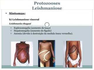 Protozooses
                      Leishmaniose
• Sintomas:
 b) Leishmaniose visceral
 Leishmania chagasi
  o Esplenomegalia (aumento do baço)
  o Hepatomegalia (aumento do fígado)
  o Anemia (devido à destruição da medula óssea vermelha).
 