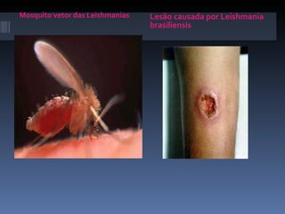 Mosquito vetor das Leishmanias Lesão causada por Leishmania brasiliensis 