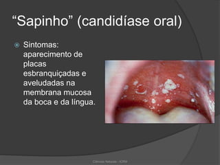 “Sapinho” (candidíase oral)
 Sintomas:
aparecimento de
placas
esbranquiçadas e
aveludadas na
membrana mucosa
da boca e da língua.
Ciências Naturais - ICRM
 