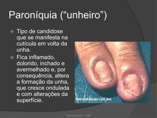 Paroníquia (“unheiro”)
 Tipo de candidose
que se manifesta na
cutícula em volta da
unha.
 Fica inflamado,
dolorido, inchado e
avermelhado e, por
consequência, altera
a formação da unha,
que cresce ondulada
e com alterações da
superfície.
Ciências Naturais - ICRM
 