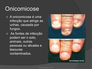Onicomicose
 A onicomicose é uma
infecção que atinge as
unhas, causada por
fungos.
 As fontes de infecção
podem ser o solo,
animais, outras
pessoas ou alicates e
tesouras
contaminados.
Ciências Naturais - ICRM
 
