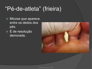 “Pé-de-atleta” (frieira)
 Micose que aparece
entre os dedos dos
pés.
 É de resolução
demorada.
Ciências Naturais - ICRM
 
