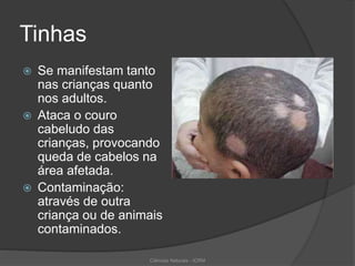 Tinhas
 Se manifestam tanto
nas crianças quanto
nos adultos.
 Ataca o couro
cabeludo das
crianças, provocando
queda de cabelos na
área afetada.
 Contaminação:
através de outra
criança ou de animais
contaminados.
Ciências Naturais - ICRM
 