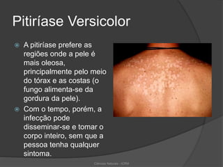 Pitiríase Versicolor
 A pitiríase prefere as
regiões onde a pele é
mais oleosa,
principalmente pelo meio
do tórax e as costas (o
fungo alimenta-se da
gordura da pele).
 Com o tempo, porém, a
infecção pode
disseminar-se e tomar o
corpo inteiro, sem que a
pessoa tenha qualquer
sintoma.
Ciências Naturais - ICRM
 