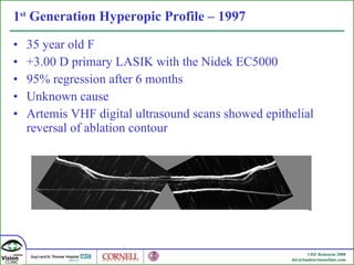 1 st  Generation Hyperopic Profile – 1997 35 year old F +3.00 D primary LASIK with the Nidek EC5000 95% regression after 6 months Unknown cause Artemis VHF digital ultrasound scans showed epithelial reversal of ablation contour 