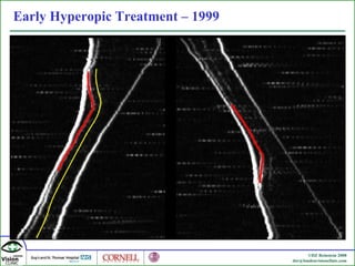 Early Hyperopic Treatment – 1999 