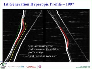 Scans demonstrate the inadequacies of the ablation profile design Short transition zone used 1st Generation Hyperopic Profile – 1997 