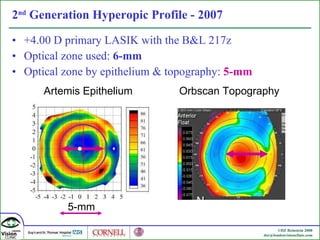 2 nd  Generation Hyperopic Profile - 2007 +4.00 D primary LASIK with the B&L 217z Optical zone used:  6-mm Optical zone by epithelium & topography:  5-mm Artemis Epithelium Orbscan Topography 5-mm 