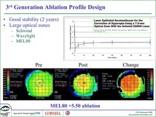 3 rd  Generation Ablation Profile Design Good stability (2 years) Large optical zones Schwind Wavelight MEL80 Pre Post Change MEL80 +5.50 ablation 
