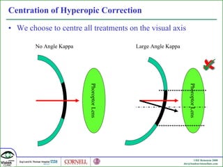 Centration of Hyperopic Correction We choose to centre all treatments on the visual axis Phoroptor Lens No Angle Kappa Large Angle Kappa Phoroptor Lens 