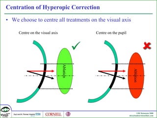 Centration of Hyperopic Correction We choose to centre all treatments on the visual axis Centre on the visual axis Centre on the pupil Ablation Ablation 