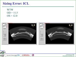 Sizing Error: ICL WTW  OD = 11.5 OS = 12.0 