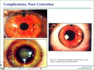 Complications: Poor Centration  Alio et al – The Kelman duet phakic intraocular lens: 1-year results – J Refract Surg. 2007;23(9):868-79 