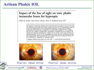 Artisan  Phakic IOL Digital image preop  Slide Courtesy B Dick MD Digital image postop  