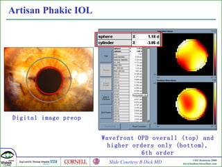 Artisan  Phakic IOL Wavefront OPD overall (top) and higher orders only (bottom), 6th order Digital image preop  Slide Courtesy B Dick MD 