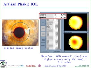 Artisan  Phakic IOL Wavefront OPD overall (top) and higher orders only (bottom), 6th order Digital image postop  Slide Courtesy B Dick MD 