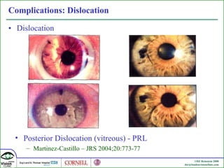 Complications: Dislocation Dislocation Posterior Dislocation (vitreous) - PRL Martinez-Castillo – JRS 2004;20:773-77 