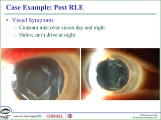 Case Example: Post RLE Visual Symptoms Constant mist over vision day and night Halos; can’t drive at night 