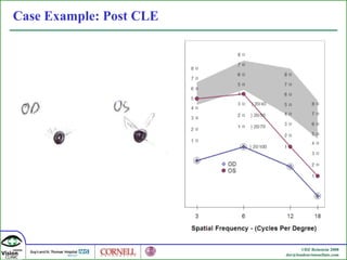 Case Example: Post CLE 