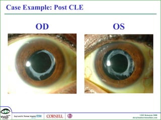 Case Example: Post CLE OD OS 