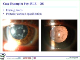 Case Example: Post RLE – OS Elshnig pearls  Posterior capsule opacification 