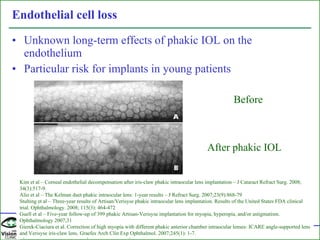 Endothelial cell loss Unknown long-term effects of phakic IOL on the endothelium Particular risk for implants in young patients  Before After phakic IOL  Kim et al – Corneal endothelial decompensation after iris-claw phakic intraocular lens implantation – J Cataract Refract Surg. 2008; 34(3):517-9. Alio et al – The Kelman duet phakic intraocular lens: 1-year results – J Refract Surg. 2007;23(9):868-79 Stulting et al – Three-year results of Artisan/Verisyse phakic intraocular lens implantation. Results of the United States FDA clinical trial. Ophthalmology. 2008; 115(3): 464-472 Guell et al – Five-year follow-up of 399 phakic Artisan-Verisyse implantation for myopia, hyperopia, and/or astigmatism. Ophthalmology 2007;31 Gierek-Ciaciura et al. Correction of high myopia with different phakic anterior chamber intraocular lenses: ICARE angle-supported lens and Verisyse iris-claw lens. Graefes Arch Clin Exp Ophthalmol. 2007;245(1): 1-7. 