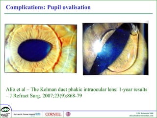 Complications: Pupil ovalisation  Alio et al – The Kelman duet phakic intraocular lens: 1-year results – J Refract Surg. 2007;23(9):868-79 