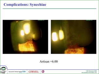 Complications: Synechiae Artisan +6.00  