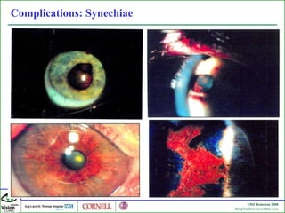 Complications: Synechiae  