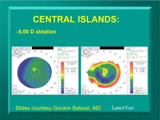CENTRAL ISLANDS: Slides courtesy Gordon Balazsi, MD -5.00 D ablation  