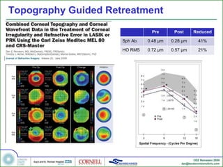 Topography Guided Retreatment Pre Post Reduced Sph Ab 0.48 µm 0.28 µm 41% HO RMS 0.72 µm 0.57 µm 21% 