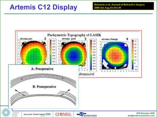 Artemis C12 Display Reinstein et al. Journal of Refractive Surgery 2000 Jul-Aug;16:414-30 Roberts C. The cornea is not a piece of plastic. JRS 2000; 16:407-413 VHF digital ultrasound 