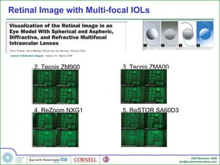 Zmb00 Introduction to Refractive Eye Surgery | PPT
