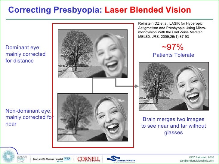 Laser Blended Vision for Presbyopia