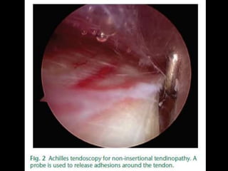 Rejul   journal club- tendoscopy