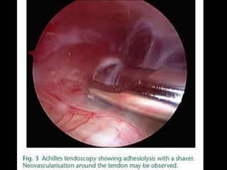 Rejul   journal club- tendoscopy
