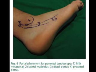 Rejul   journal club- tendoscopy