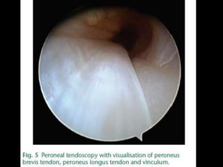 Rejul   journal club- tendoscopy