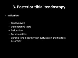 3. Posterior tibial tendoscopy
• Indications
– Tenosynovitis
– Degenerative tears
– Dislocation
– Enthesopathies
– Chronic tendinopathy with dysfunction and flat foot
deformity
 