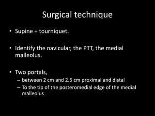 Surgical technique
• Supine + tourniquet.
• Identify the navicular, the PTT, the medial
malleolus.
• Two portals,
– between 2 cm and 2.5 cm proximal and distal
– To the tip of the posteromedial edge of the medial
malleolus
 