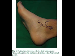 Rejul   journal club- tendoscopy